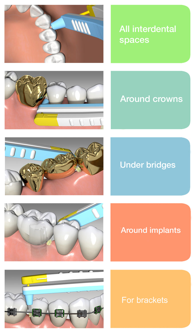 The Wingbrush: Revolution of Interdental Cleaning Set